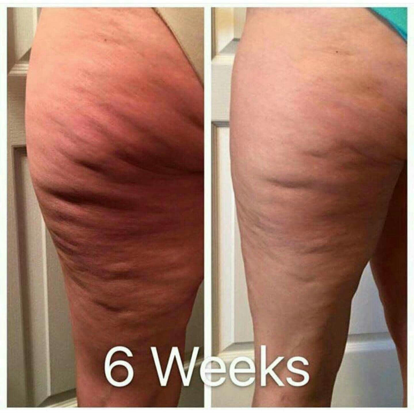 GlowHaven™ Cellulite Relief Kit